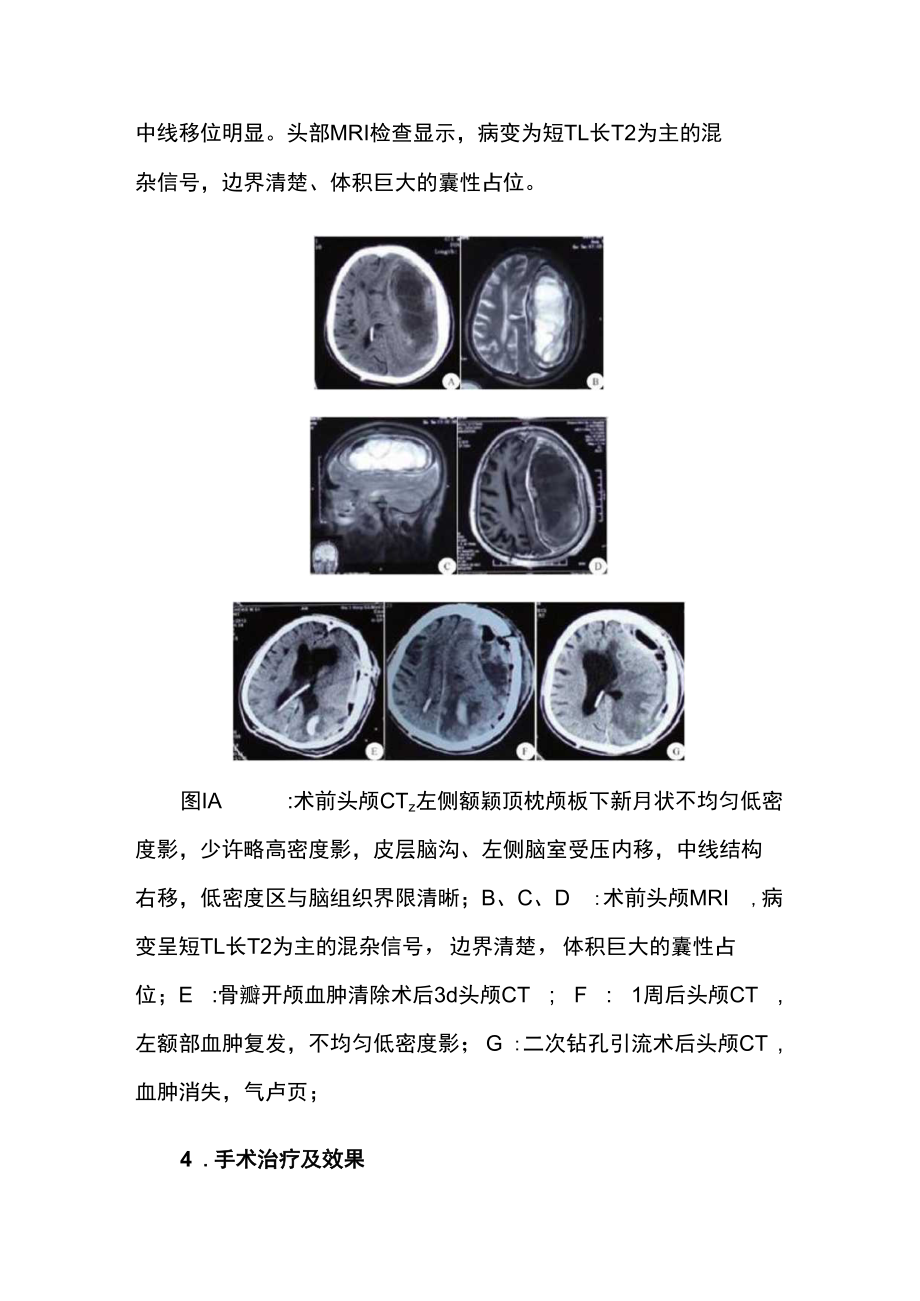 脑外科医师医师晋升副主任（主任）医师例分析专题报告（额颞顶枕部机化型慢性硬膜下血肿）.docx_第3页