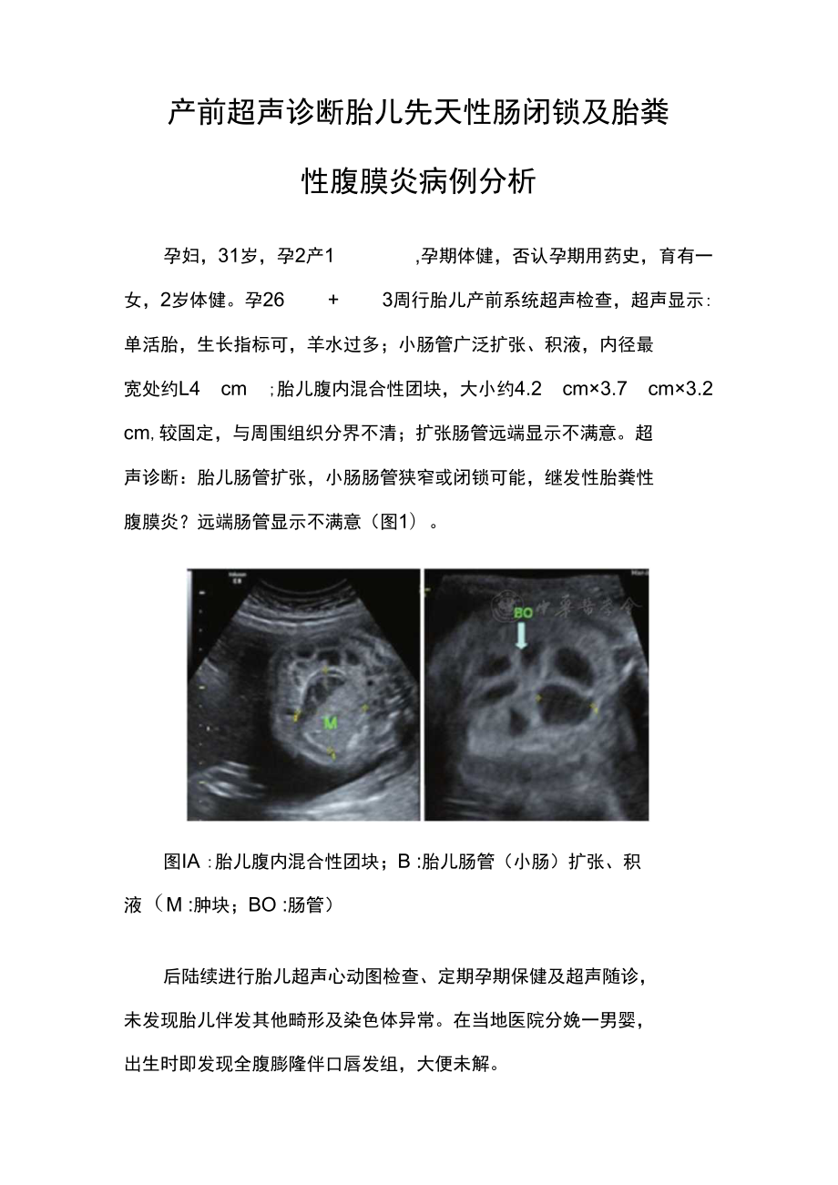 超声科医师晋升副主任（主任）医师例分析专题报告（产前超声诊断胎儿先天性肠闭锁及胎粪性腹膜炎）.docx_第2页