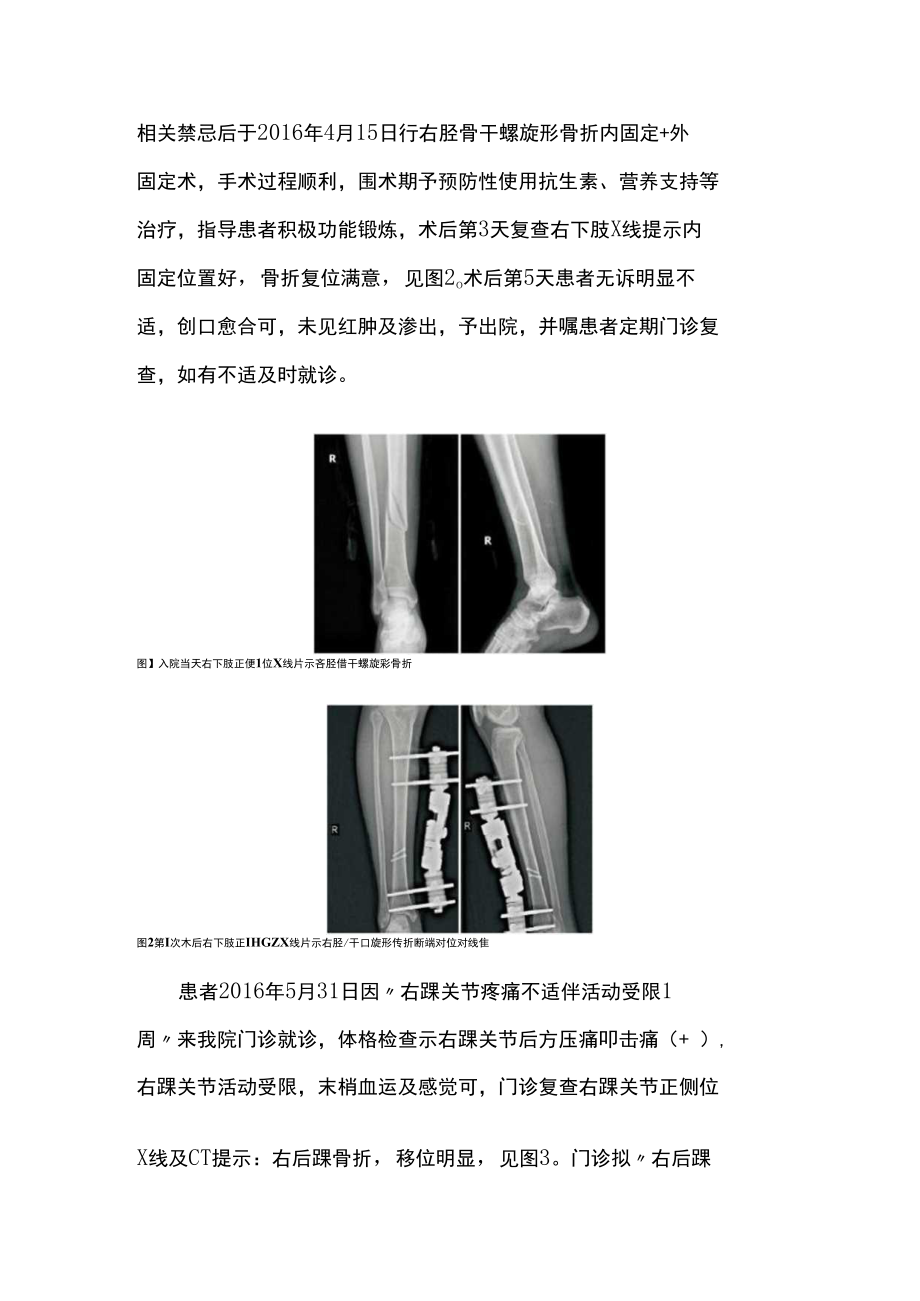 骨外科晋升副主任（主任）医师例分析专题报告（胫骨螺旋形骨折合并后踝骨折）.docx_第3页