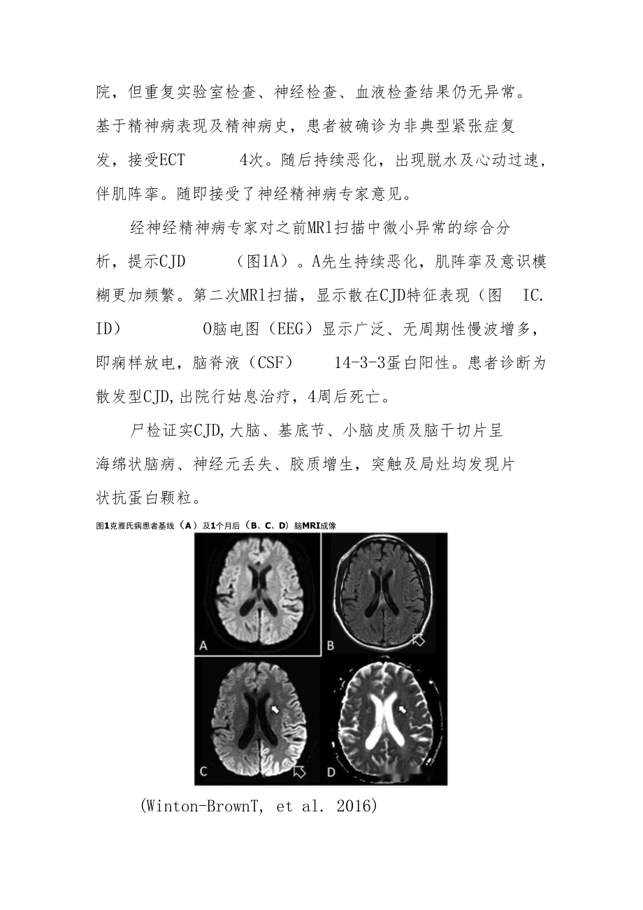 精神科医师医师晋升副主任（主任）医师高级职称例分析专题报告（以紧张症为表现的克雅氏病病例分析）.docx_第3页