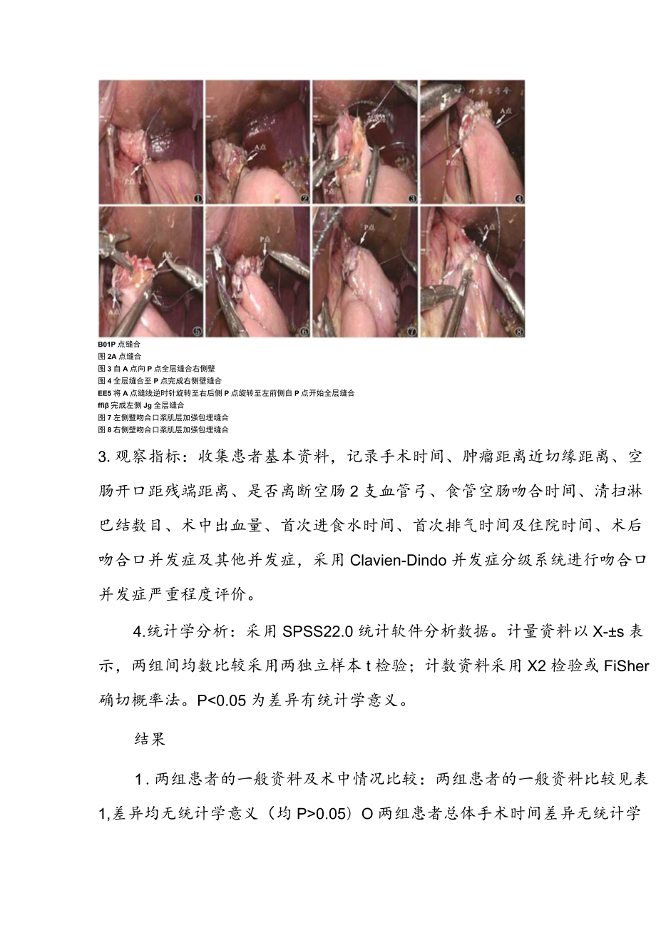 手工缝合在全腹腔镜食管胃结合部癌根治术消化道重建中的应用.docx_第3页