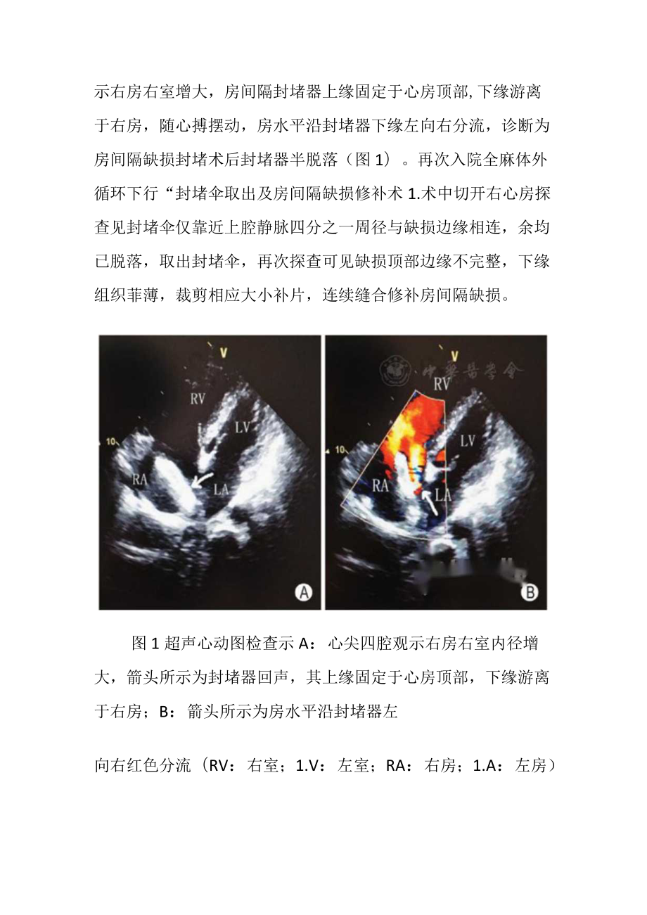 心内科医师晋升副主任（主任）医师病例分析专题报告（超声心动图诊断房间隔缺损封堵器半脱落）.docx_第3页