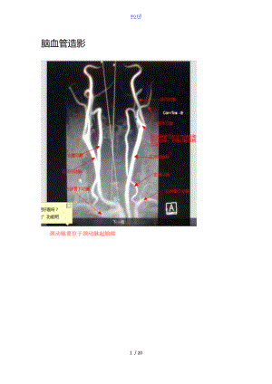 脑血管造影图片详解.doc