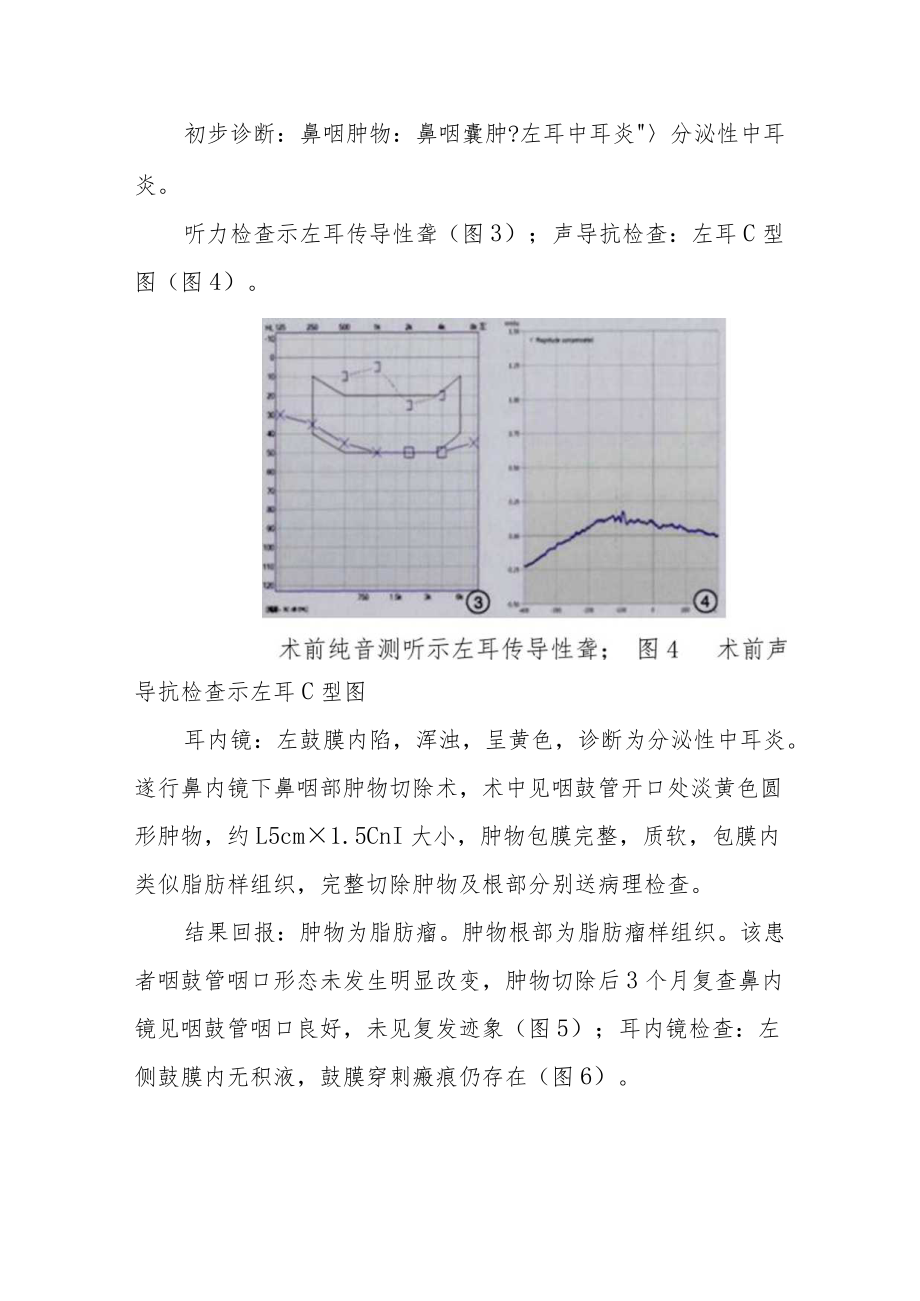 耳鼻喉科晋升副主任（主任）医师病例分析专题报告（咽鼓管咽口脂肪瘤病例分析）.docx_第3页