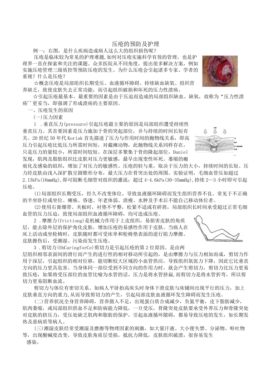 压疮的预防及护理.docx_第1页