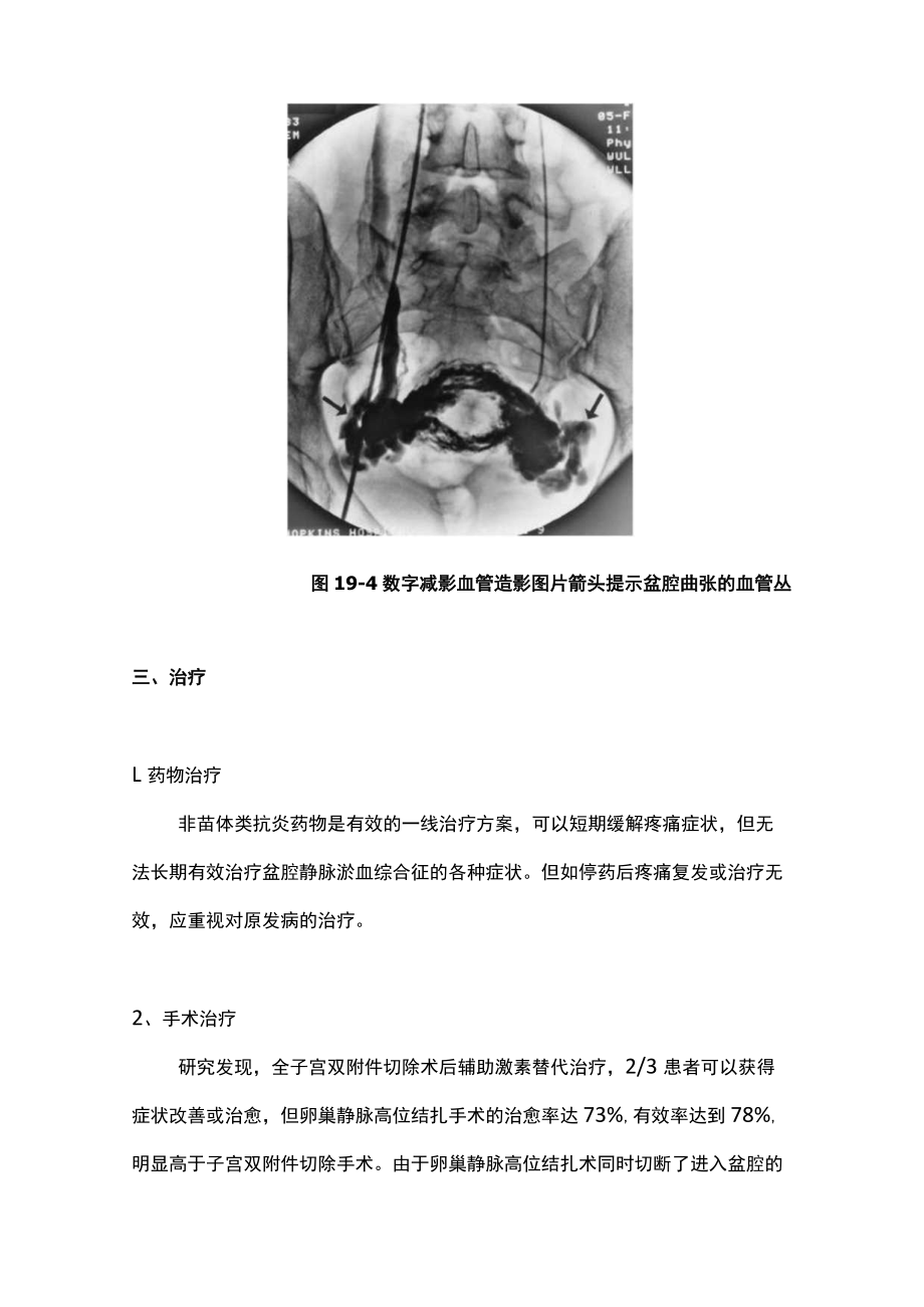 最新：盆腔静脉淤血综合征的临床诊治策略（全文）.docx_第3页