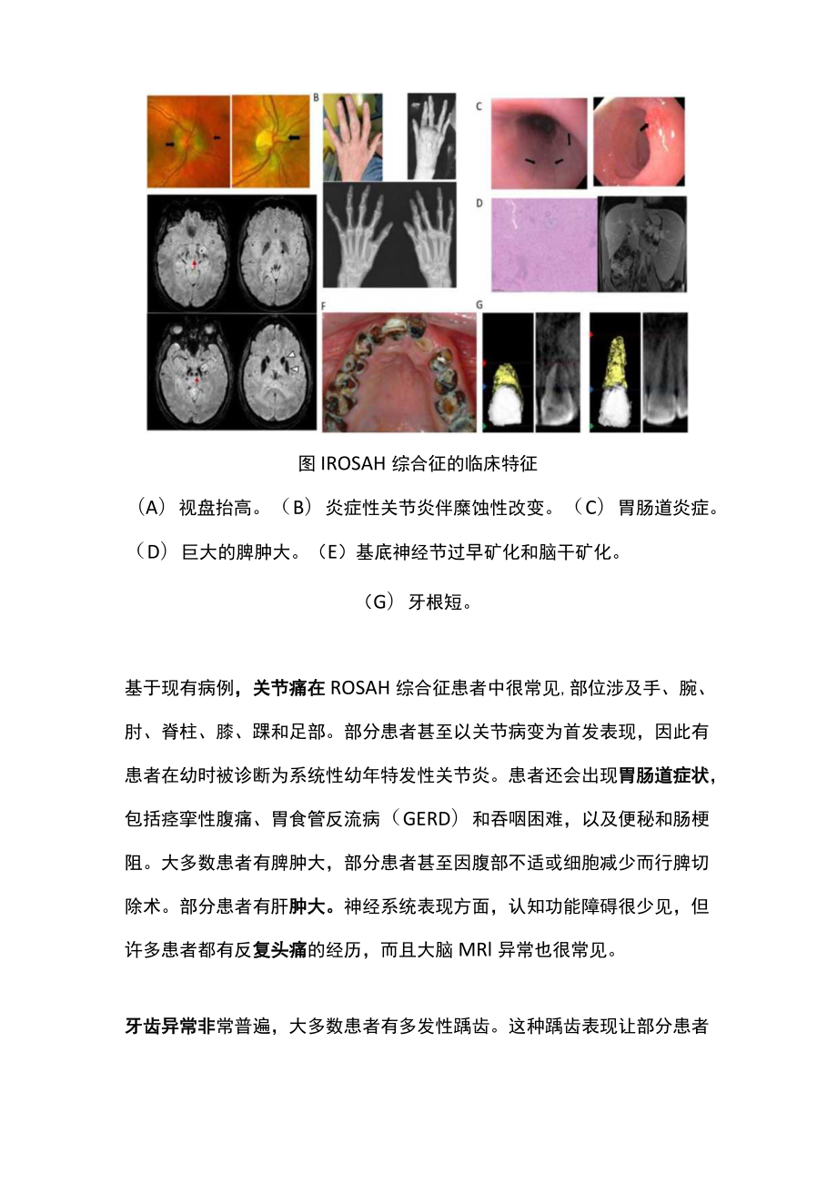 2022ROSAH综合征的临床特点与治疗（全文）.docx_第2页