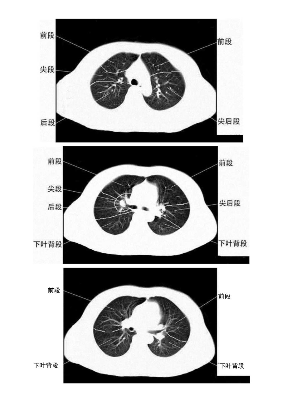 胸部CT肺段划分口诀.docx_第2页