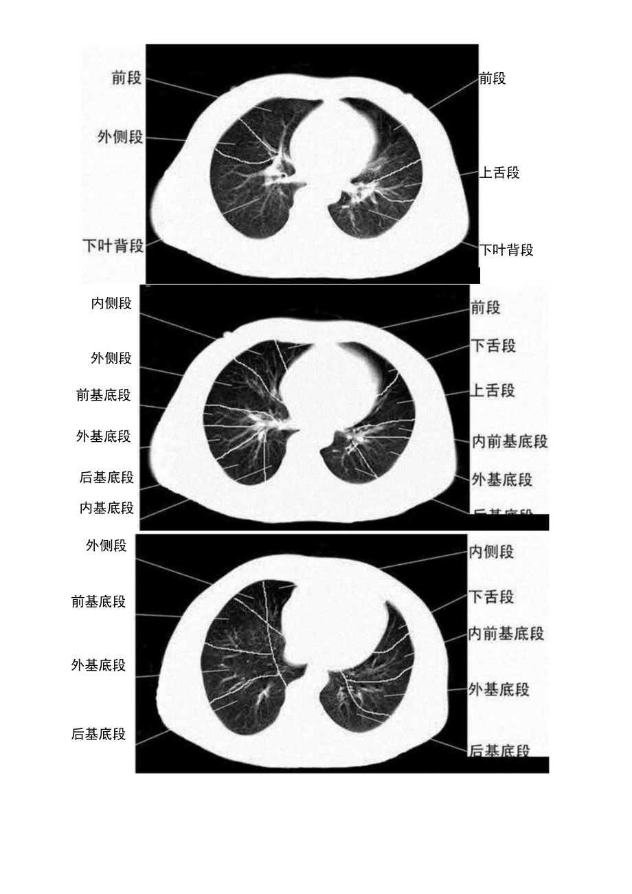 胸部CT肺段划分口诀.docx_第3页