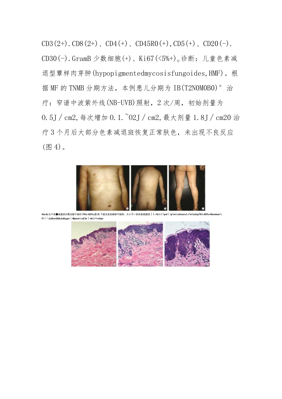 皮肤科医师晋升副主任（主任）医师病例分析专题报告（儿童色素减退型蕈样肉芽肿）.docx_第3页