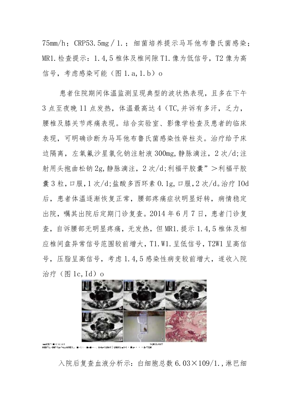 一例马耳他布鲁菌感染性脊柱炎病例分析专题报告.docx_第2页