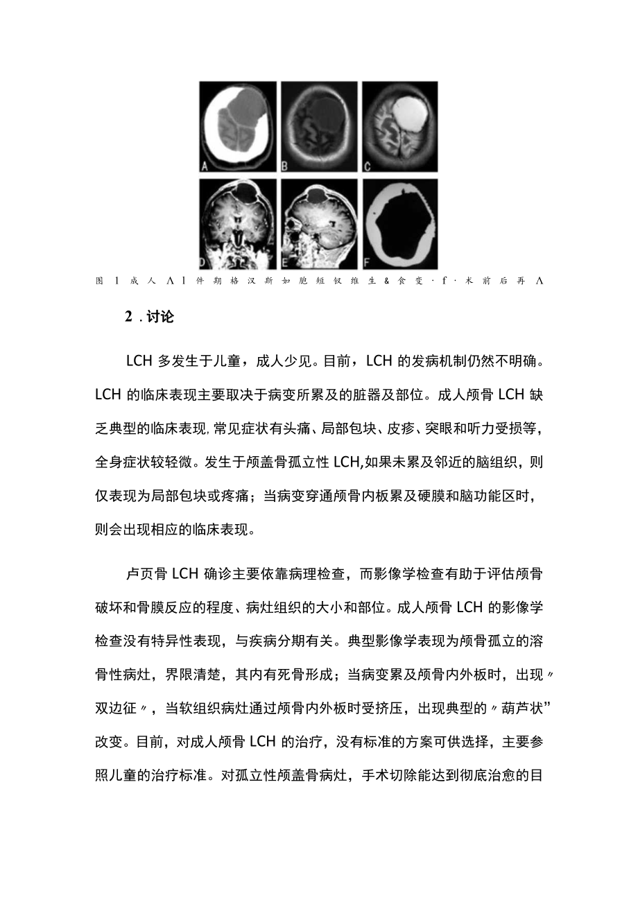 成人颅骨朗格汉斯组织细胞增生症囊变病例分析.docx_第2页