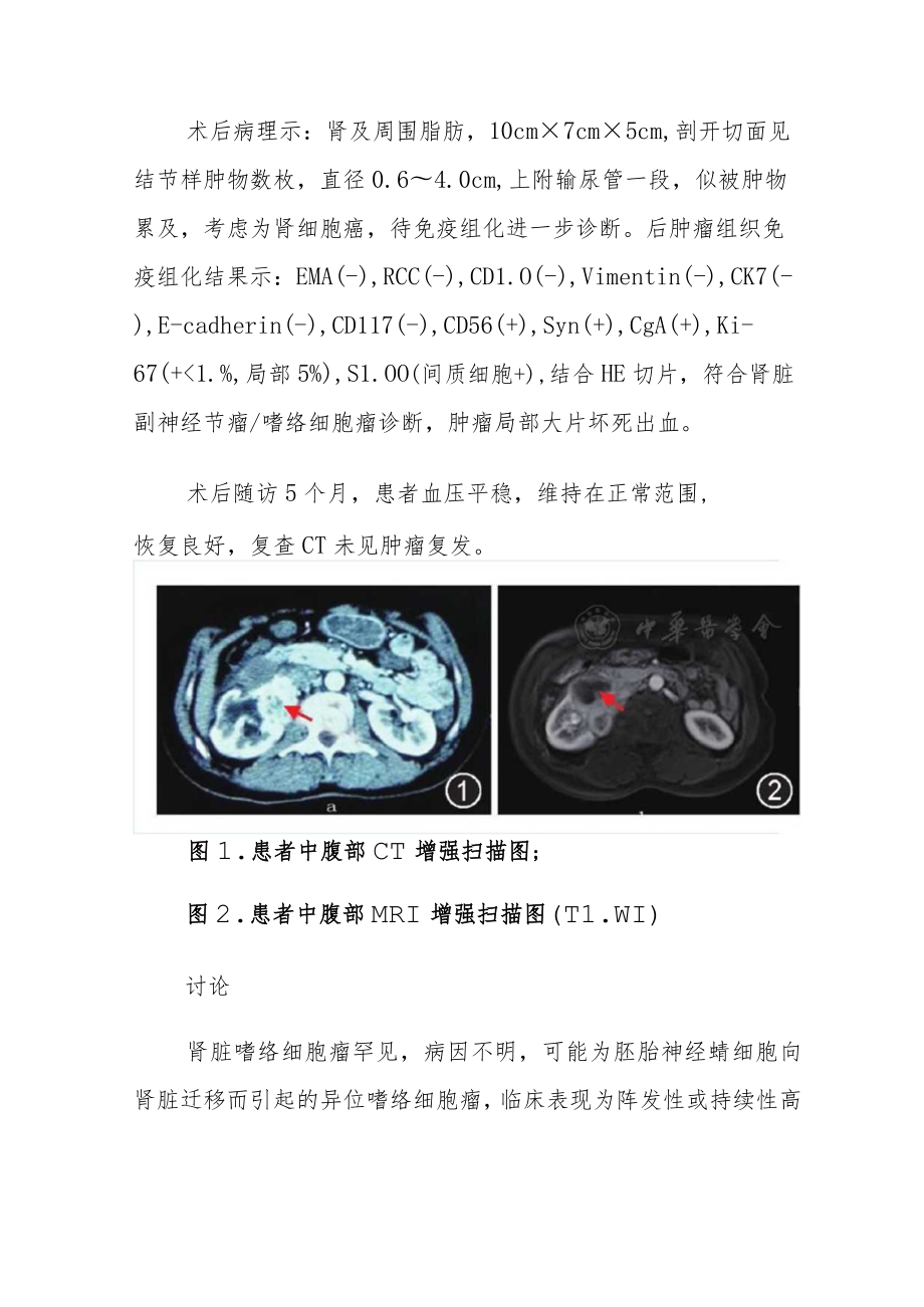 外科医师副主任（主任）医师病例分析专题报告（肾脏嗜铬细胞瘤）.docx_第3页