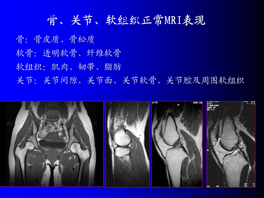 磁共振成像诊断骨关节及软组织疾病.ppt_第3页