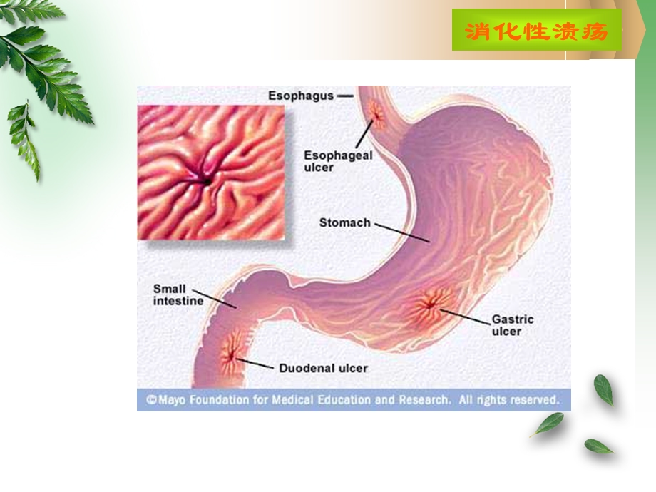 病例消化性溃疡名师编辑PPT课件.ppt_第2页
