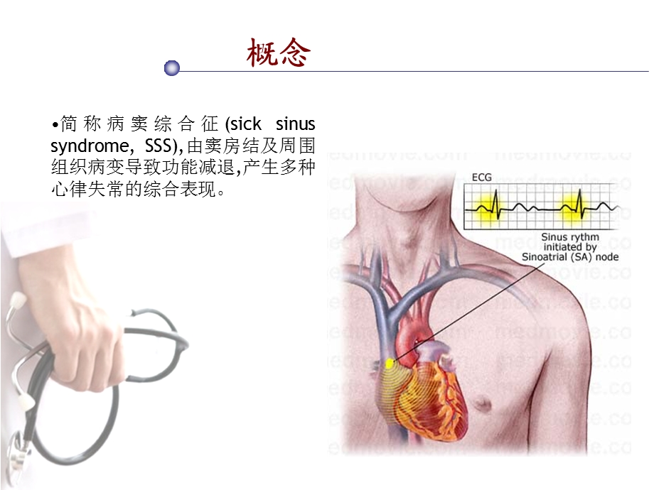 病态窦房结综合征.ppt_第2页