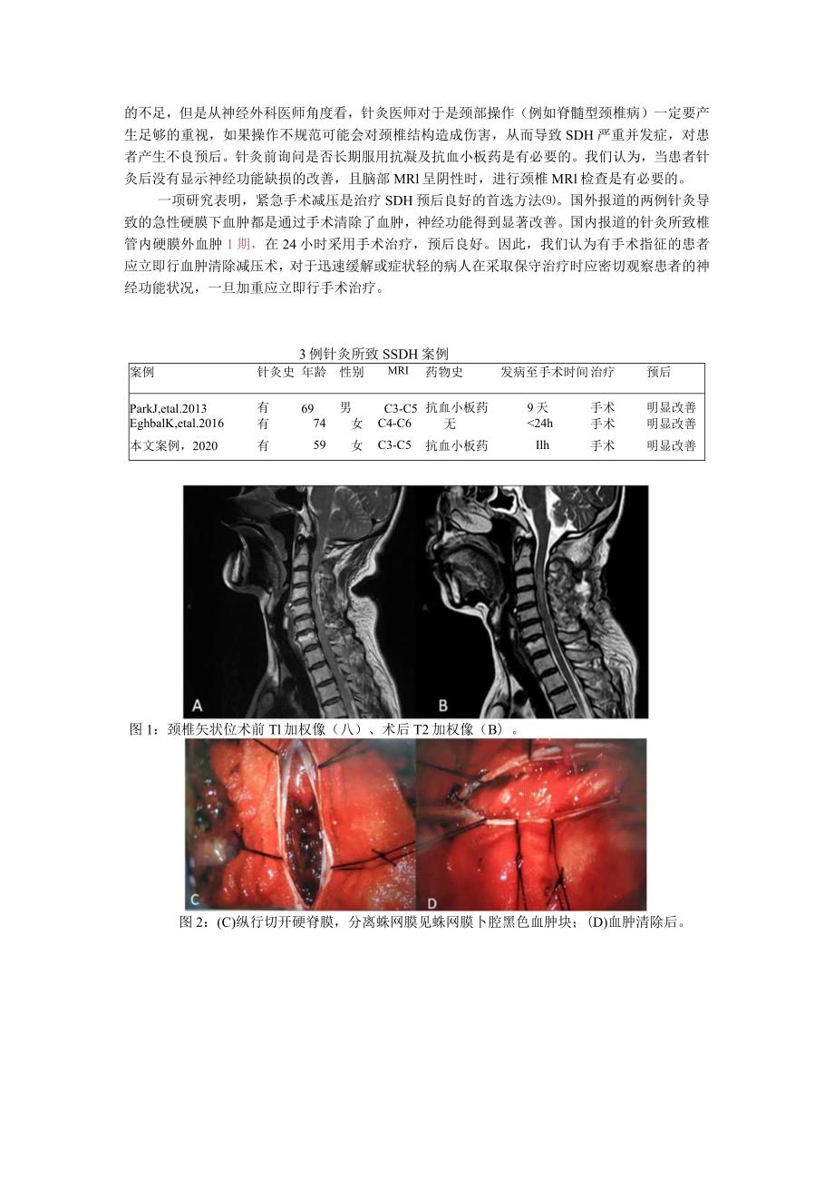 针灸引发颈部脊髓硬膜下血肿一例并文献复习.docx_第3页