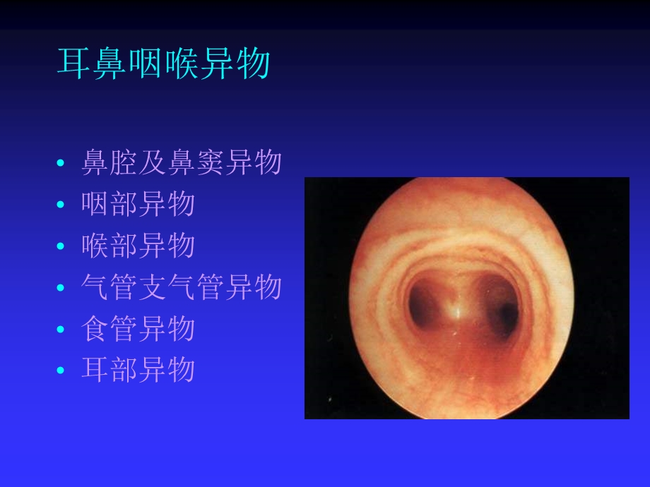 第18章耳鼻咽喉、食道及气管异物及颈部疾病——高专高职五官科学第二版课件.ppt_第2页