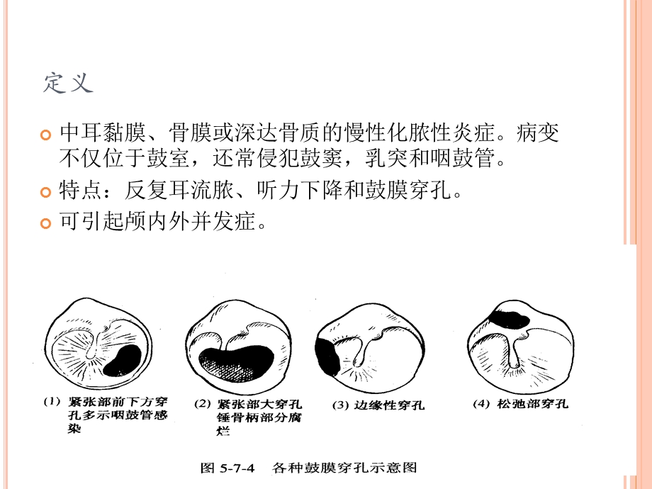 慢性化脓性中耳炎医学幻灯片.ppt_第2页