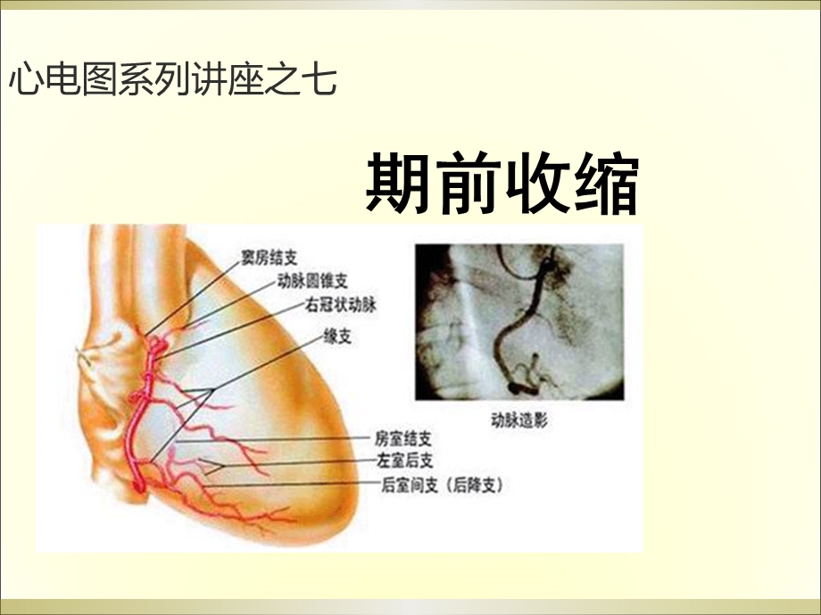 心电图系列讲座7期前收缩.ppt_第1页