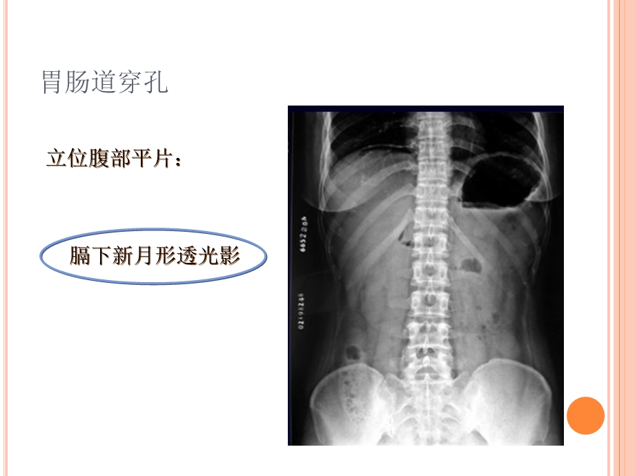 急性腹痛的影像学改变ppt课件.ppt_第2页