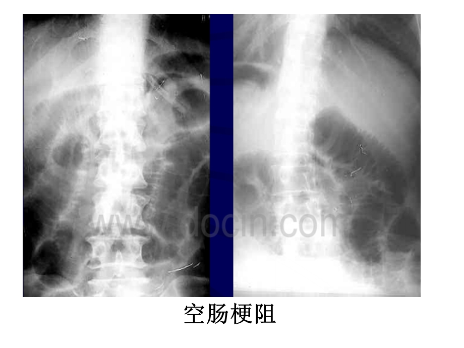 急腹症肠梗阻现象ppt课件.ppt_第2页