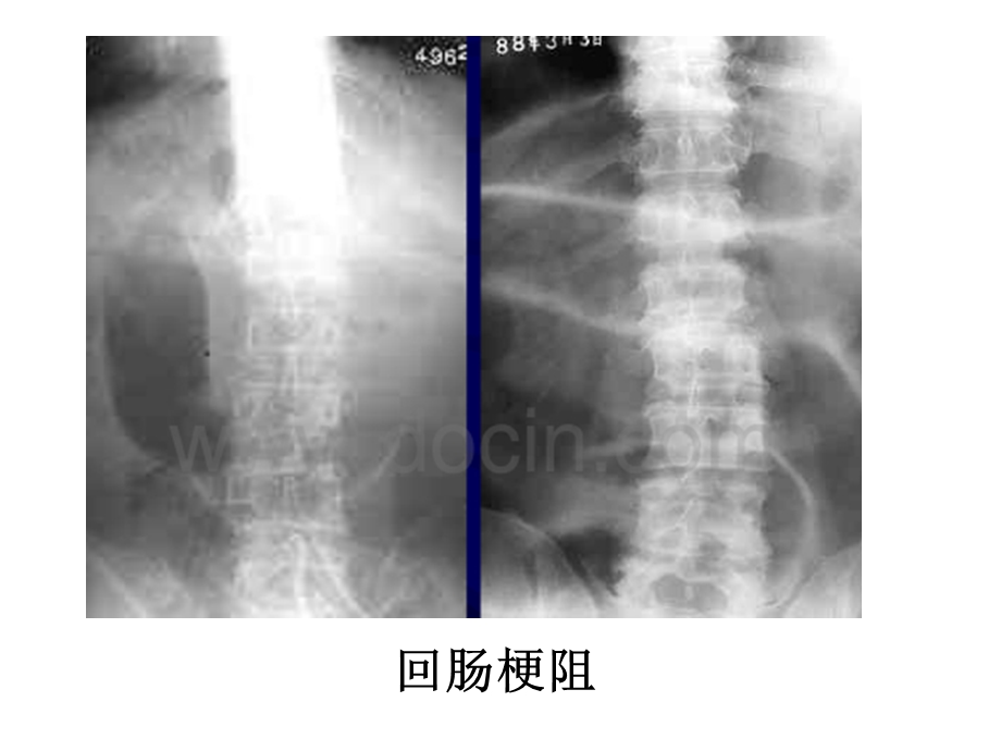 急腹症肠梗阻现象ppt课件.ppt_第3页