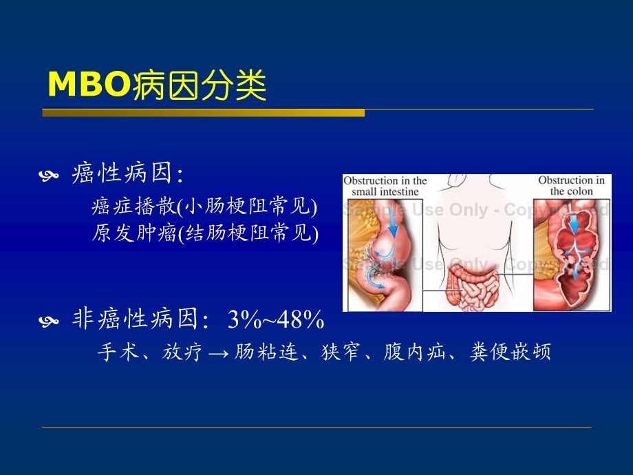 恶性肠梗阻.ppt_第3页