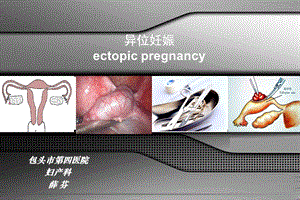 妇产科异位妊娠 .ppt