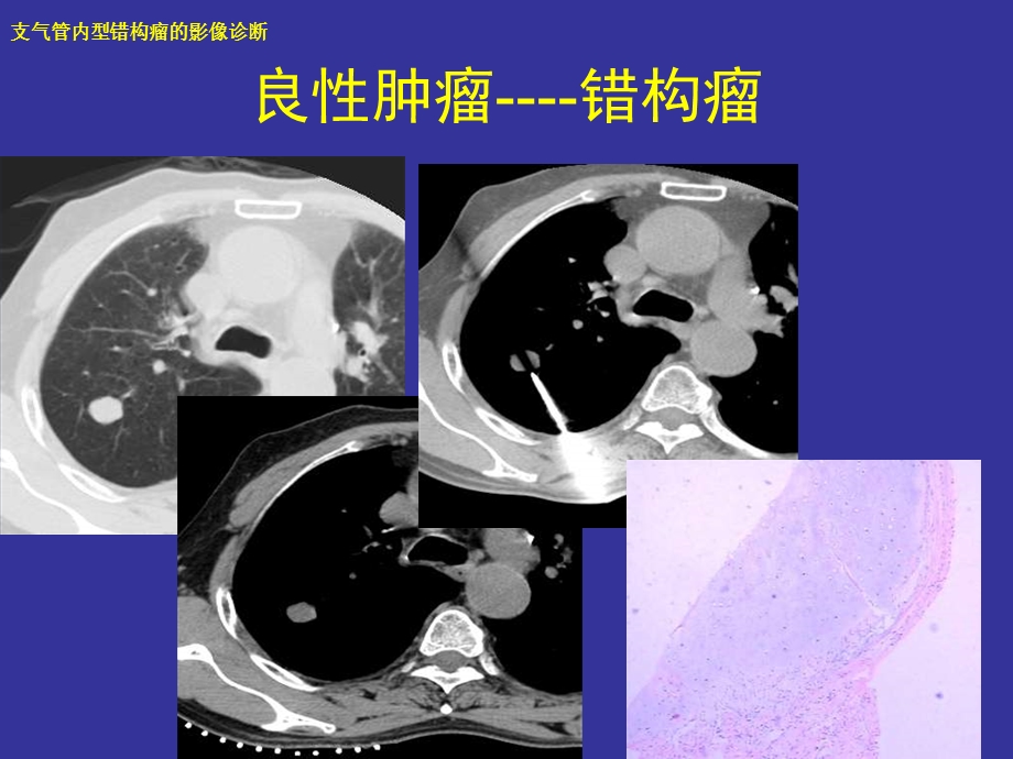 支气管内错构瘤的影像诊断.ppt_第1页