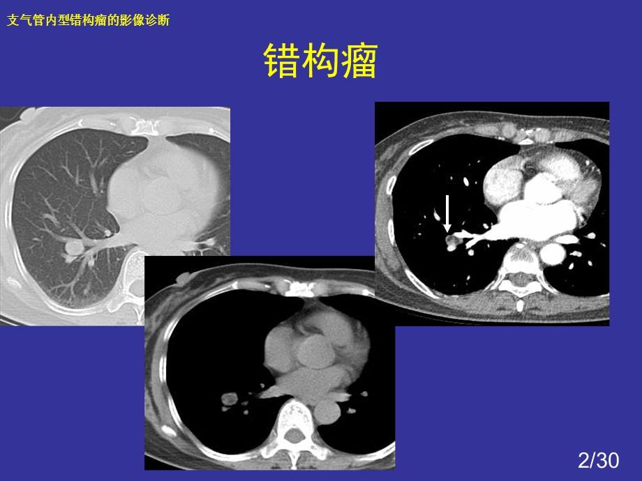 支气管内错构瘤的影像诊断.ppt_第2页