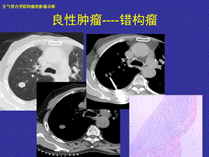 支气管内错构瘤的影像诊断.ppt