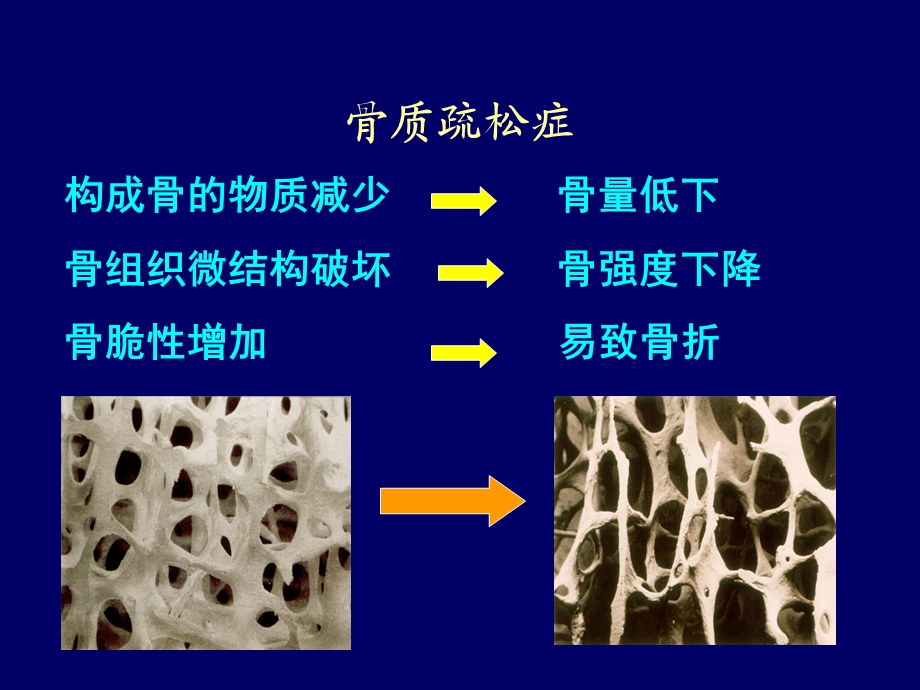 精品原发性骨质疏松症.ppt_第3页