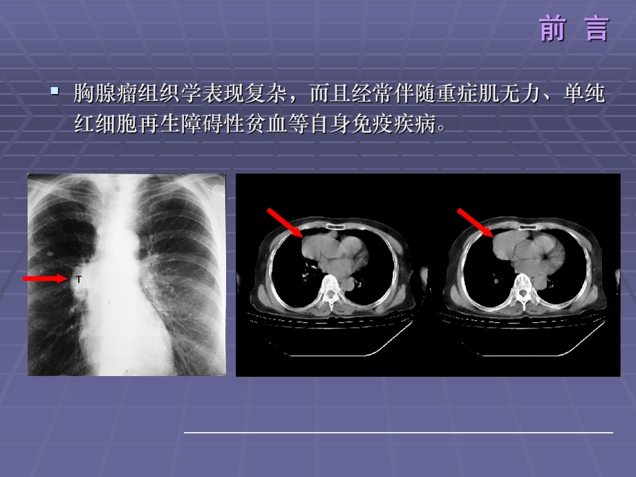 110例胸腺瘤WHO分型及Masaoka分期的回顾研究宋楠.ppt_第3页