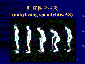 强直性脊柱炎1.ppt