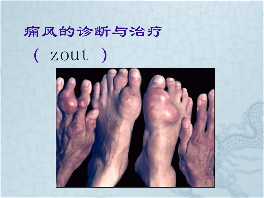 痛风的诊断与治疗讲课.ppt_第1页