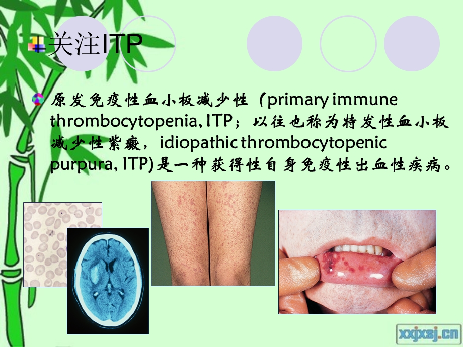 ITP的中西医诊断与治疗.ppt_第2页