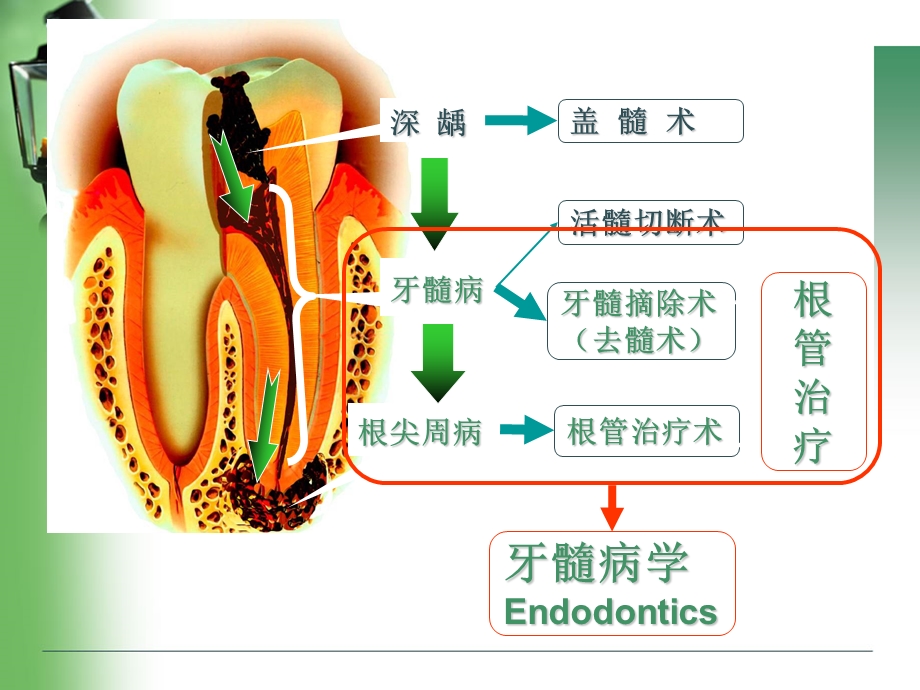 根管治疗rct.ppt_第2页