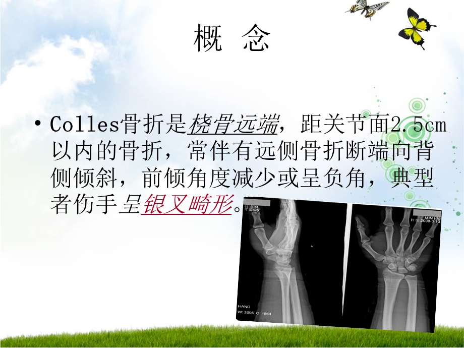 COLLES骨折可用.ppt_第3页