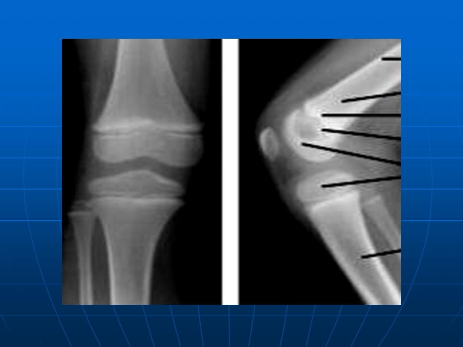 儿童骨关节损伤.ppt_第3页