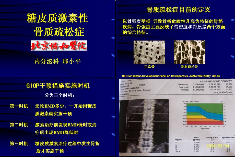 糖皮质激素性骨质疏松症.ppt_第2页