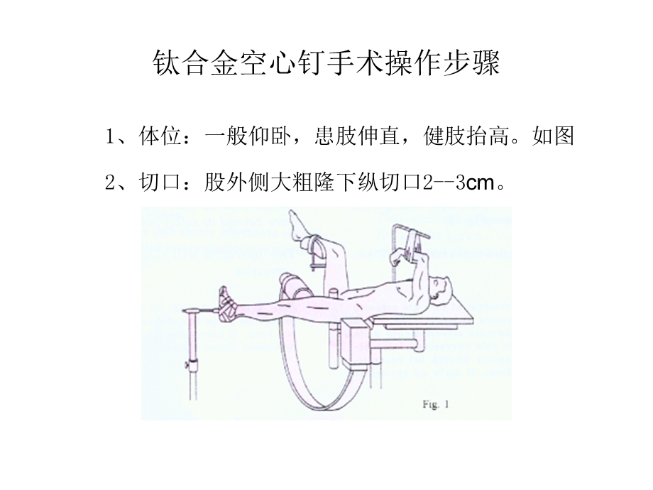 钛合金空心钉手术操作步骤.ppt_第1页