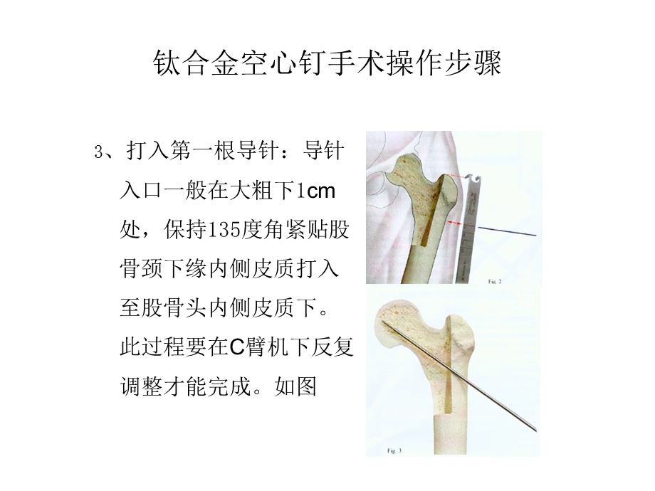 钛合金空心钉手术操作步骤.ppt_第2页