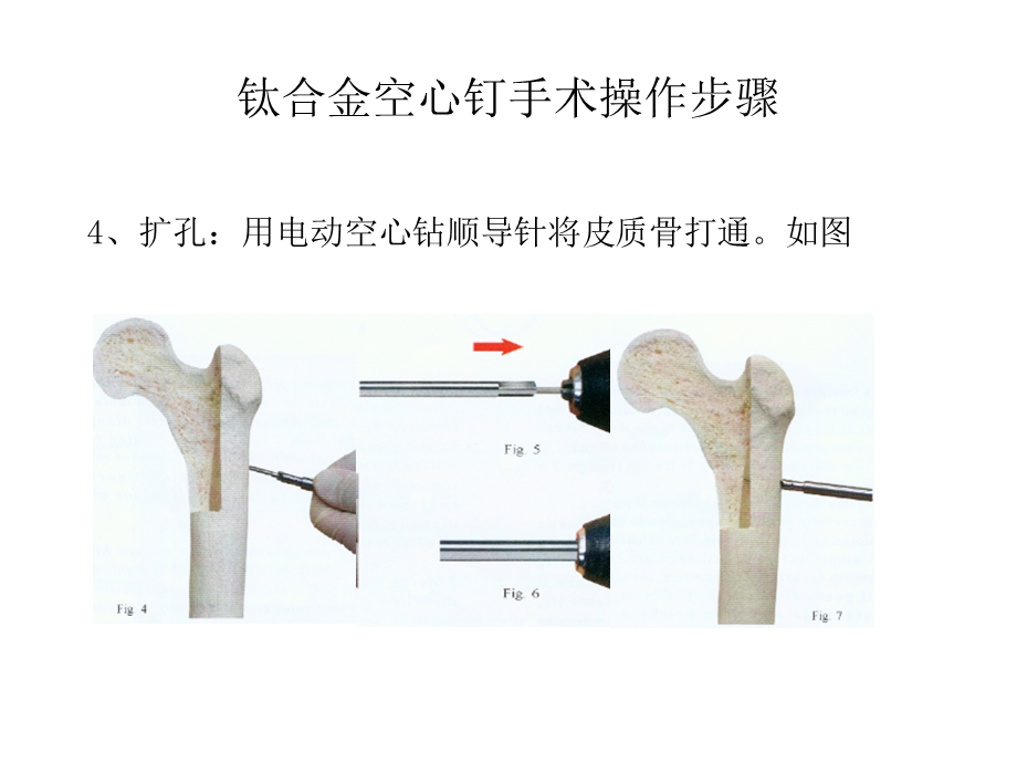 钛合金空心钉手术操作步骤.ppt_第3页