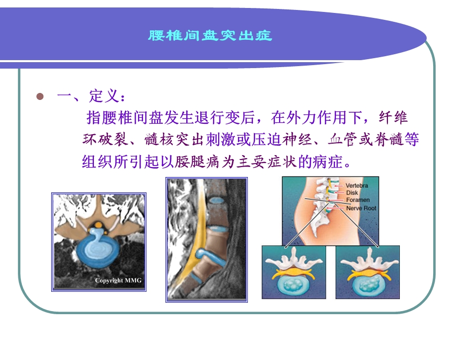 腰椎间盘突出症2.ppt_第2页