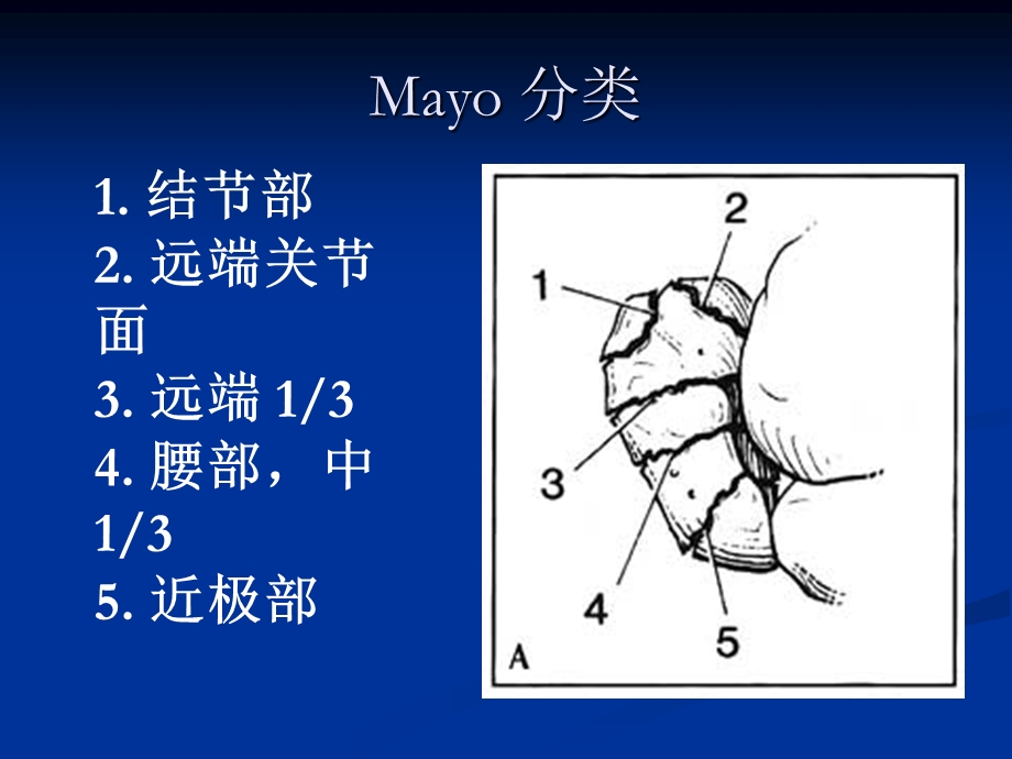 腕部舟状骨骨折.ppt_第3页