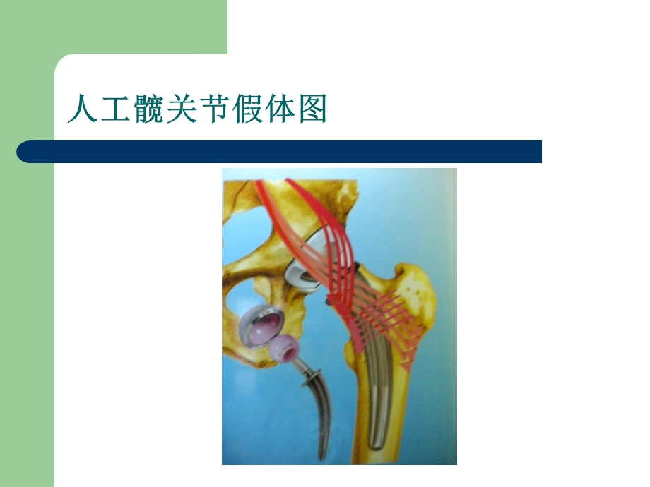 人工全髋关节置换术健康教育.ppt.ppt_第3页