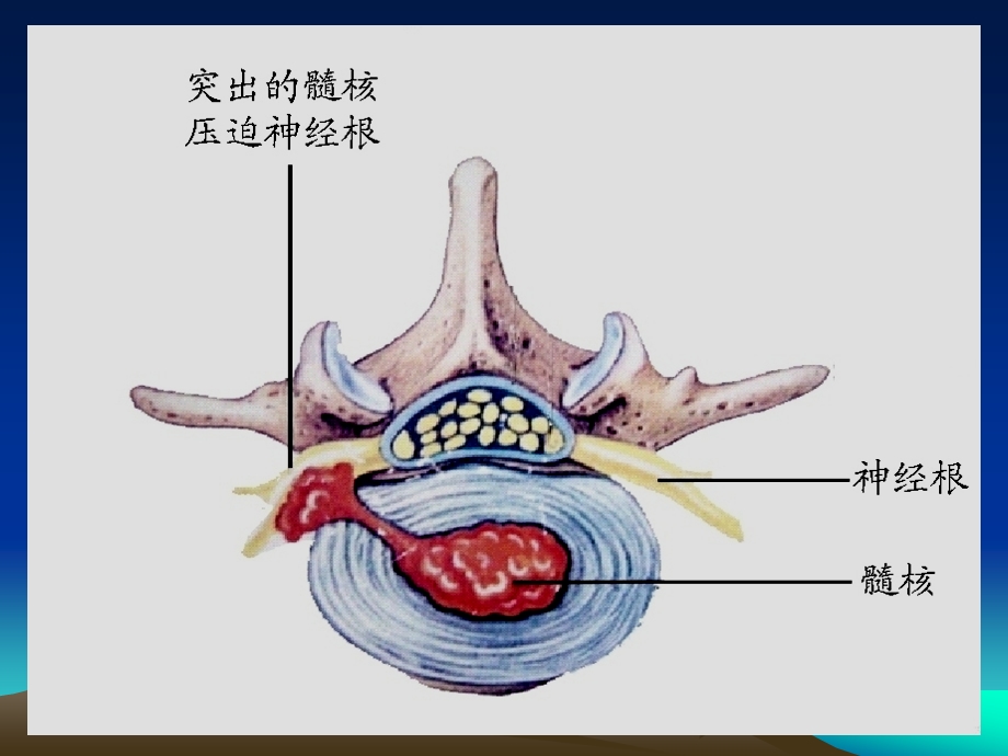 腰椎间盘突出症1.ppt_第3页