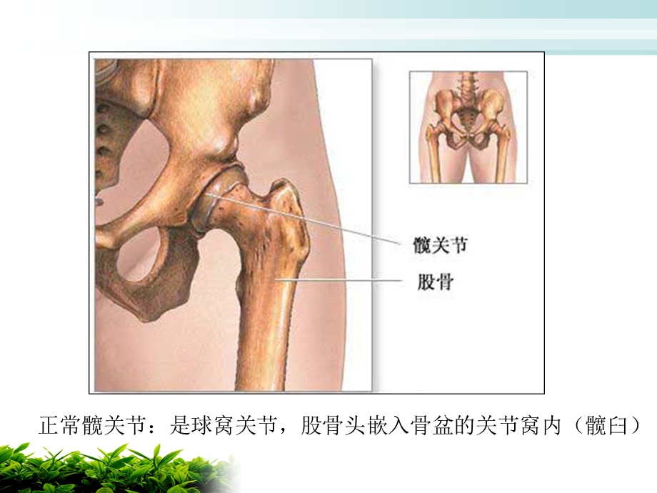 人工髋关节置换术后护理..ppt_第3页