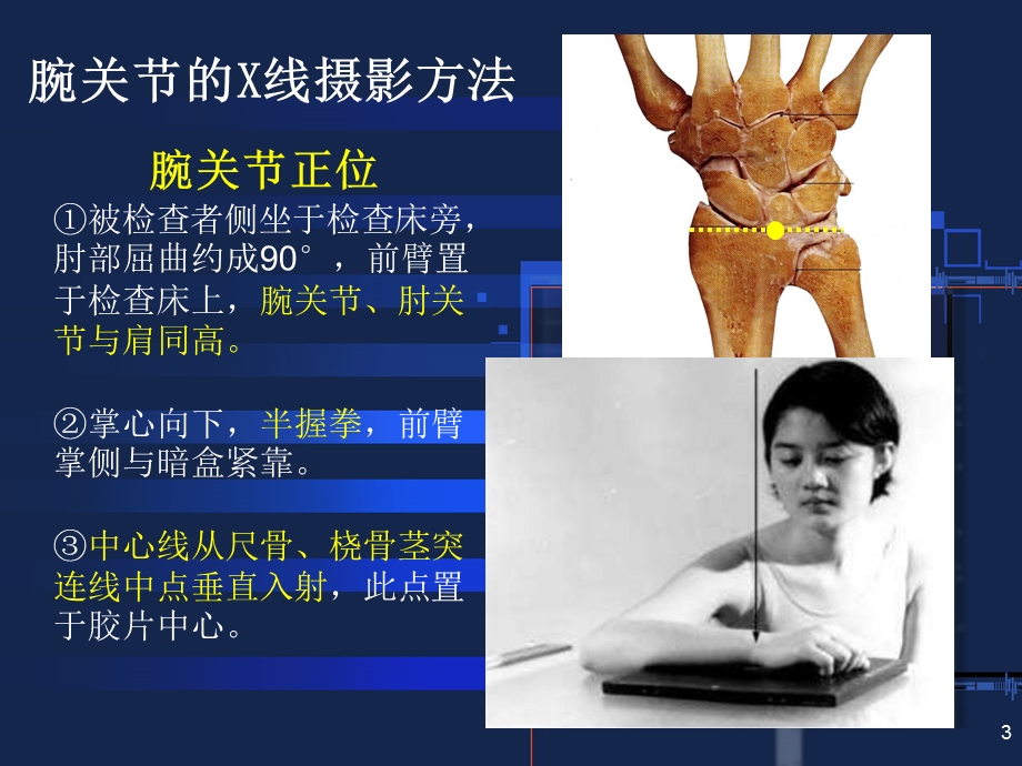 腕关节常见骨折与摄影方法.ppt_第3页